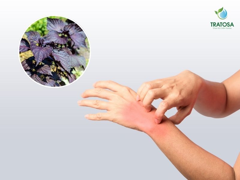 Lá tía tô giảm mề đay, mẩn ngứa