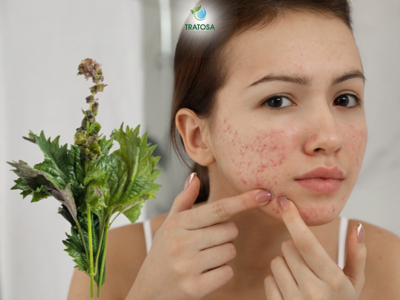 Công dụng của lá tía tô giúp trị mụn