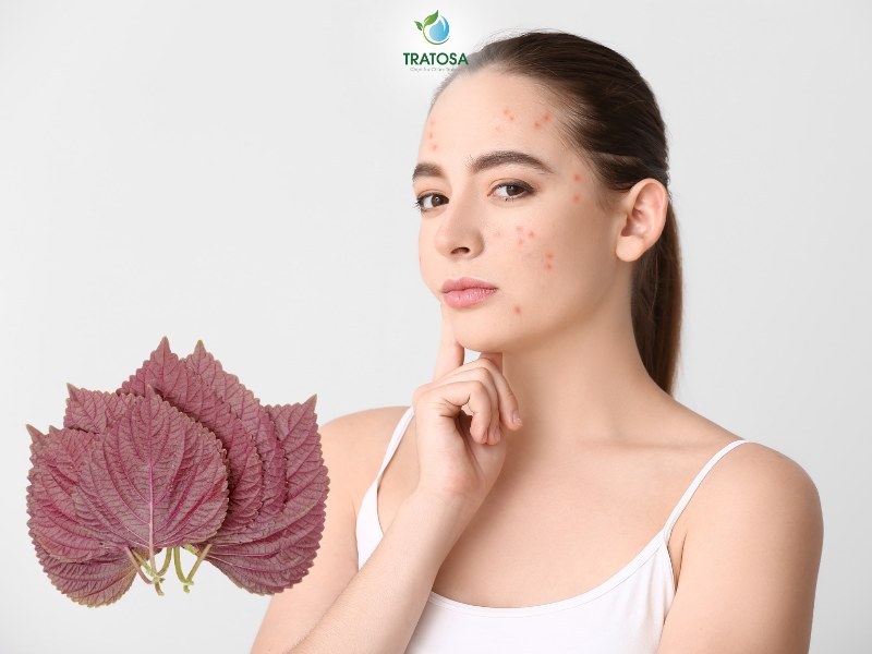 Những lưu ý khi sử dụng lá tía tô trị mụn