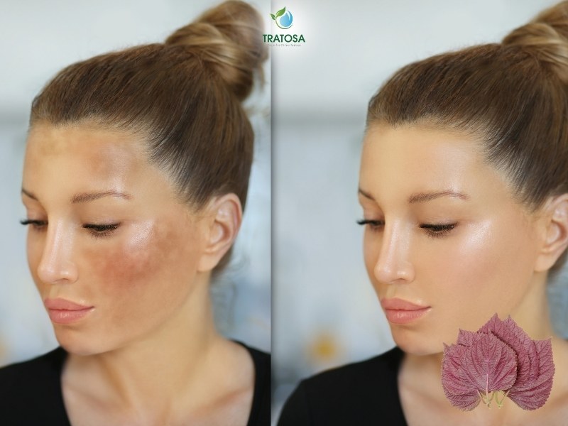 Tác dụng của lá tía tô khi điều trị nám da