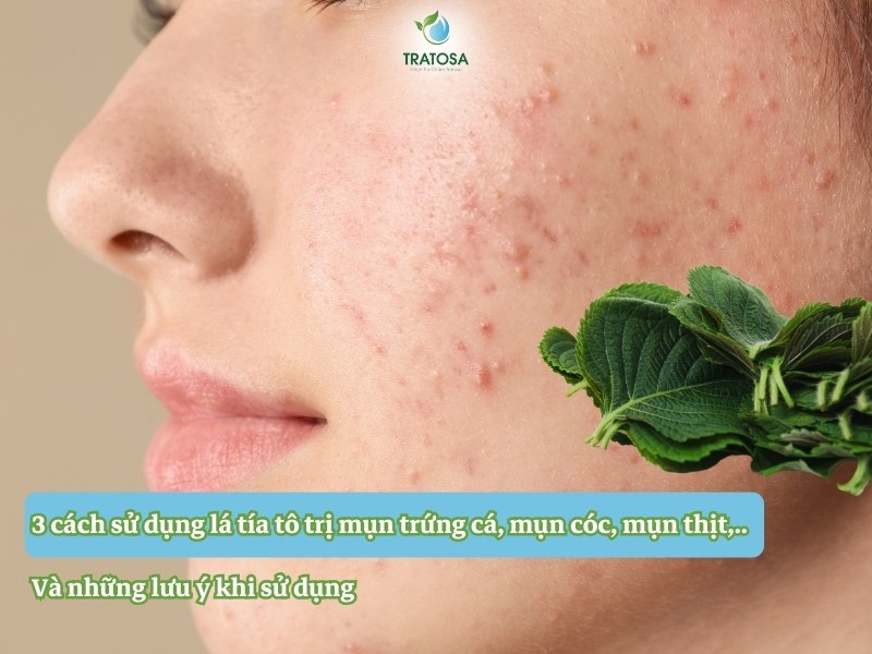 3 cách sử dụng lá tía tô trị mụn trứng cá, mụn cóc, mụn thịt,.. và những lưu ý